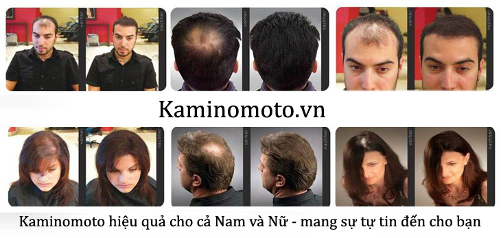 Thuốc mọc tóc, dầu gội ngăn ngừa rụng tóc của Nhật Bản, hiệu quả cao, an toàn sử dụng.