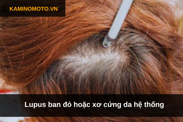 Lupus ban đỏ hoặc xơ cứng da hệ thống