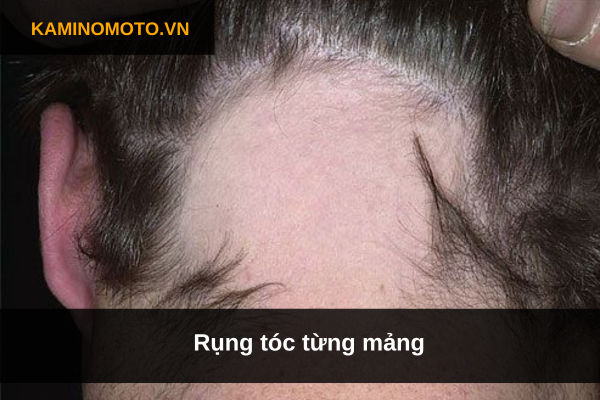 Rụng tóc từng mảng