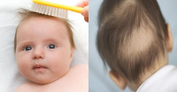 Nguyên nhân gây rụng tóc ở trẻ em