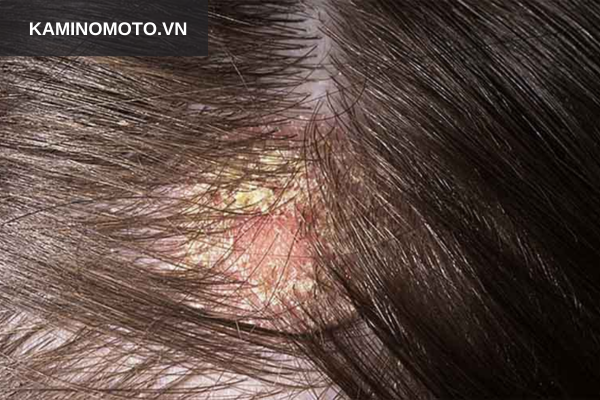 Người có da đầu bị tổn thương 