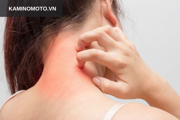 Người có tiền sử dị ứng 